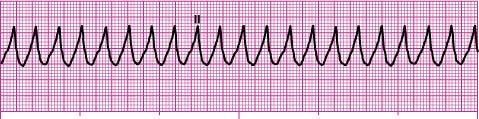 Ventricular rate/rhythm Atrial rate/rhythm PR interval QRS duration Identification 214 bpm/regular Unable to