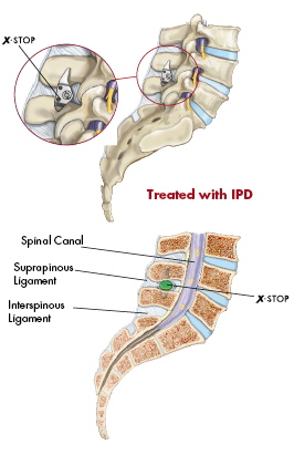 With IPD surgery or x-stop spinal stenosis surgery there is no removal of bone or soft tissue.