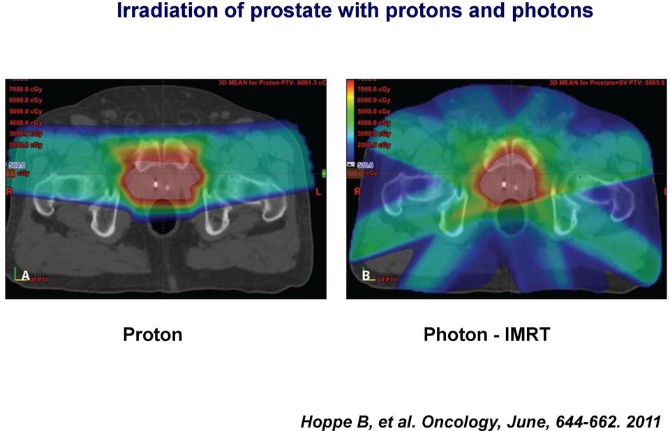 Photon - IMRT Hoppe B, et al.