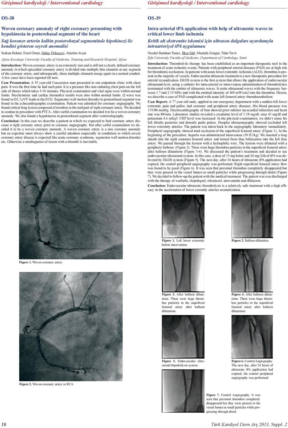 University Faculty of Medicine, Training and Research Hospital, Afyon Introduction: Woven coronary artery is an extremely rare and is still not a clearly defined coronary anomaly in which epicardial