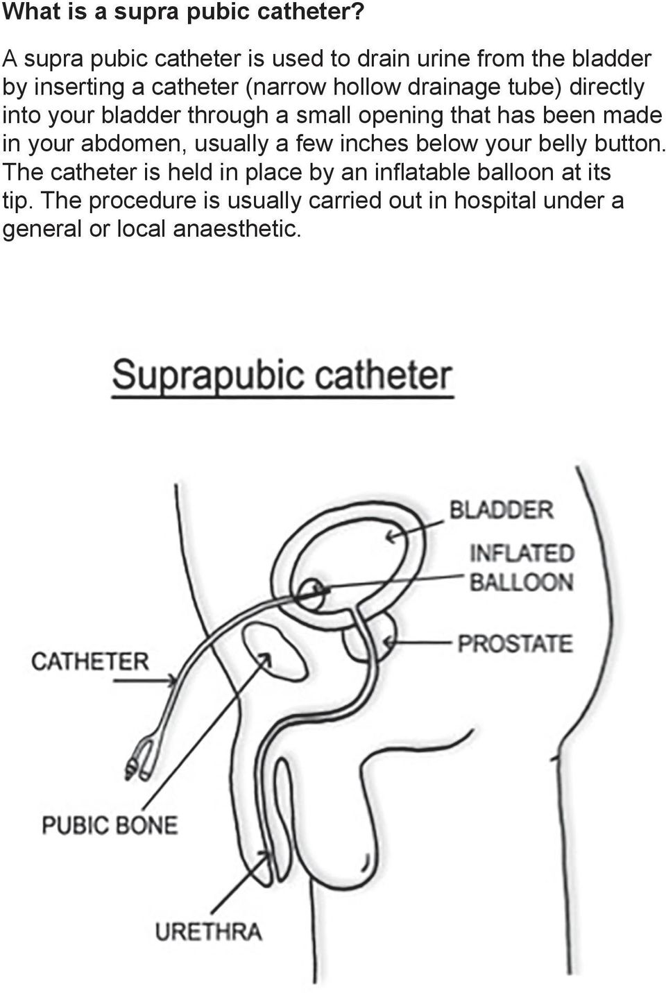 drainage tube) directly into your bladder through a small opening that has been made in your abdomen,