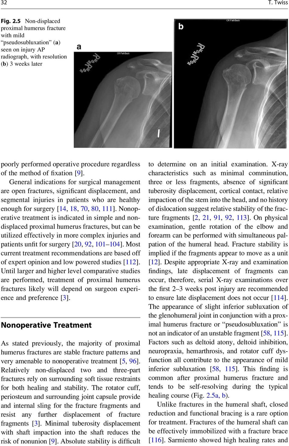 of fixation [9]. General indications for surgical management are open fractures, significant displacement, and segmental injuries in patients who are healthy enough for surgery [14, 18, 70, 80, 111].
