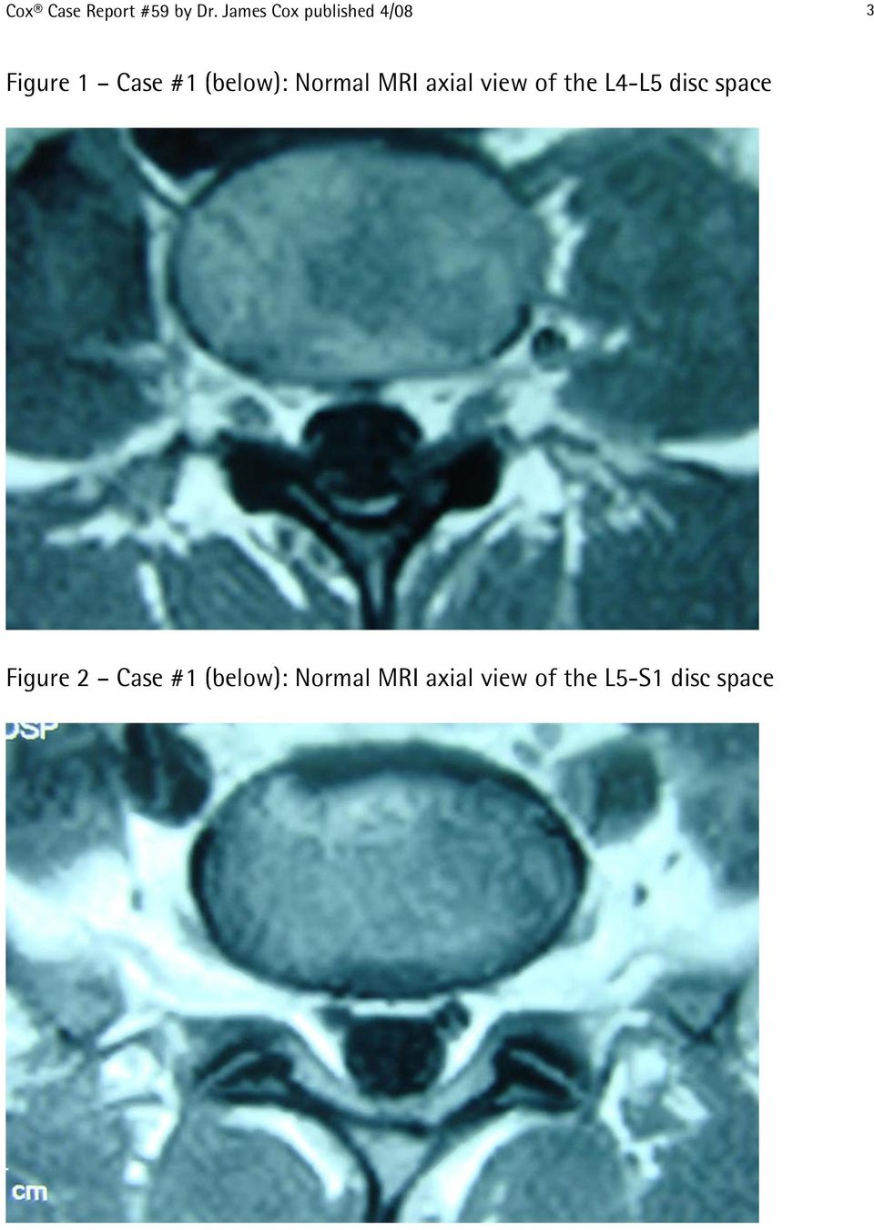(below): Normal MRI axial view of the L4-L5 disc