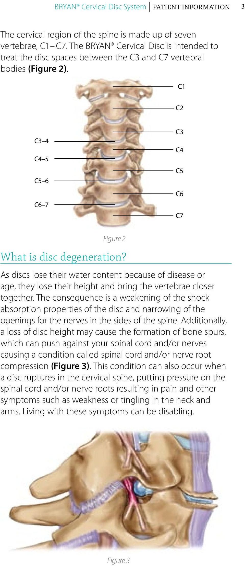 As discs lose their water content because of disease or age, they lose their height and bring the vertebrae closer together.