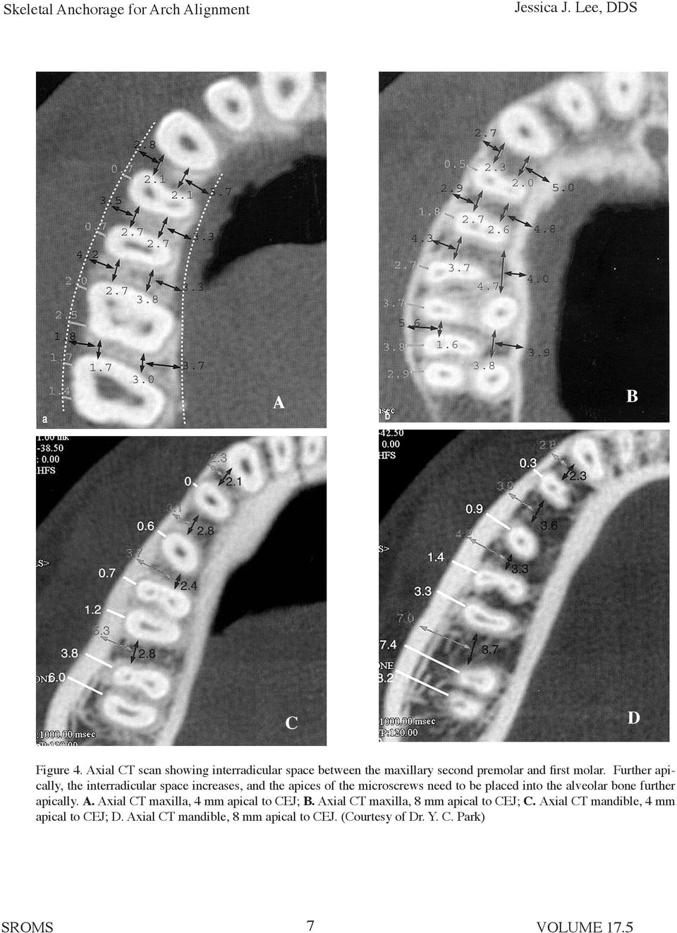 the alveolar bone further apically.. xial CT maxilla, 4 mm apical to CEJ;.