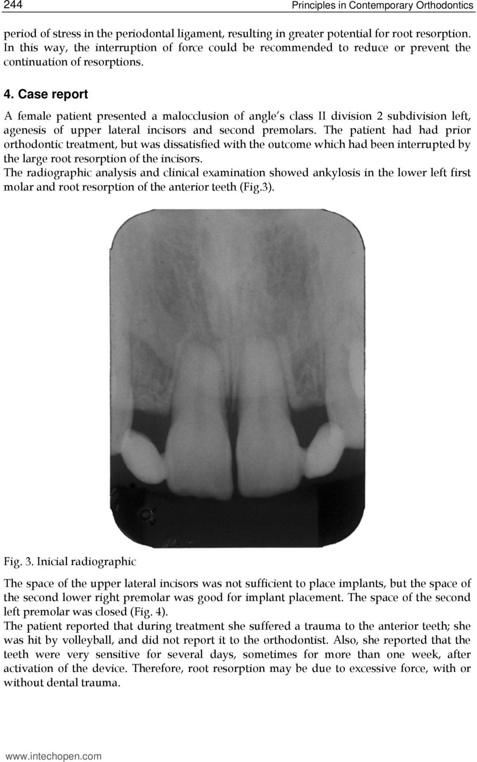 Case report A female patient presented a malocclusion of angle s class II division 2 subdivision left, agenesis of upper lateral incisors and second premolars.