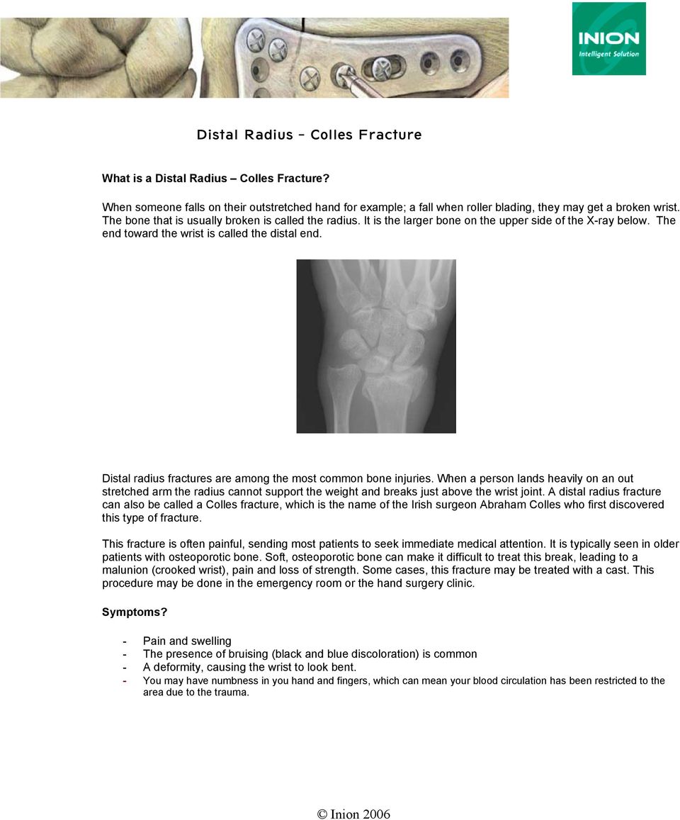 Distal radius fractures are among the most common bone injuries. When a person lands heavily on an out stretched arm the radius cannot support the weight and breaks just above the wrist joint.