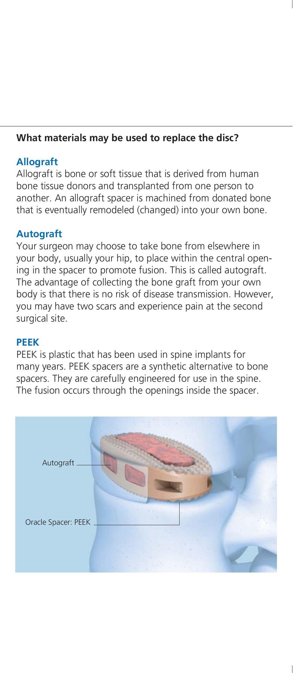 Autograft Your surgeon may choose to take bone from elsewhere in your body, usually your hip, to place within the central opening in the spacer to promote fusion. This is called autograft.