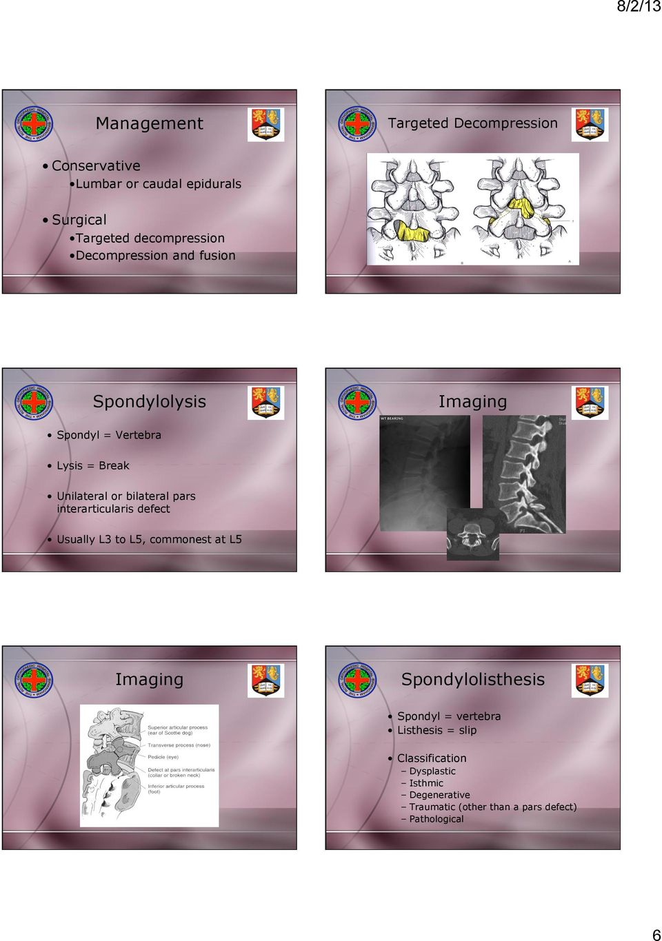 interarticularis defect Usually L3 to L5, commonest at L5 Imaging Spondylolisthesis Spondyl = vertebra