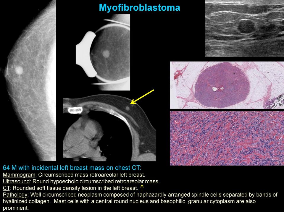 CT: Rounded soft tissue density lesion in the left breast.