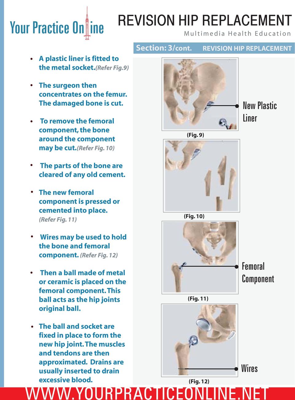 The new femoral component is pressed or cemented into place. (Refer Fig. 11) Wires may be used to hold the bone and femoral component. (Refer Fig. 12) Then a ball made of metal or ceramic is placed on the femoral component.