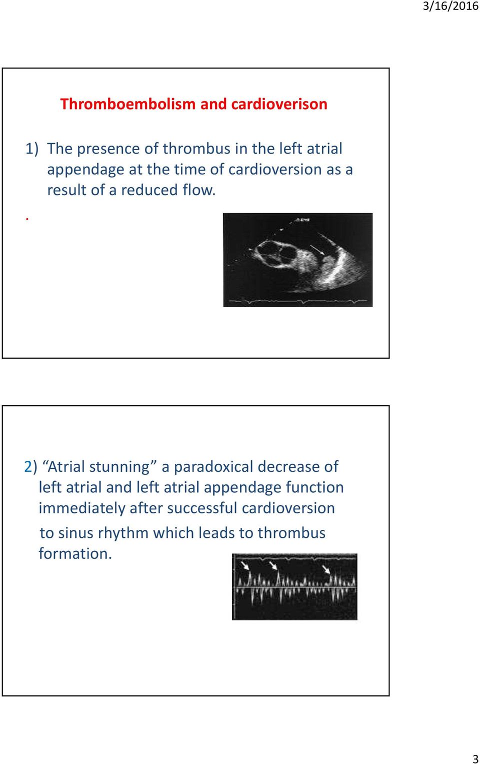. 2) Atrial stunning a paradoxical decrease of left atrial and left atrial appendage