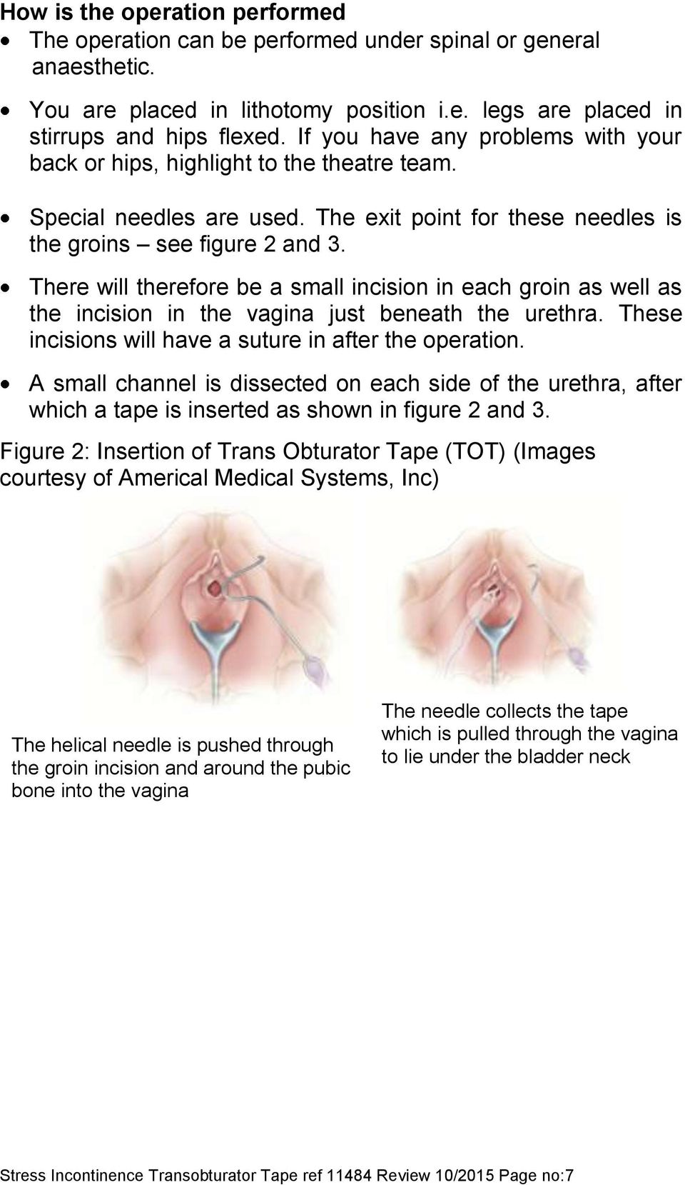 There will therefore be a small incision in each groin as well as the incision in the vagina just beneath the urethra. These incisions will have a suture in after the operation.
