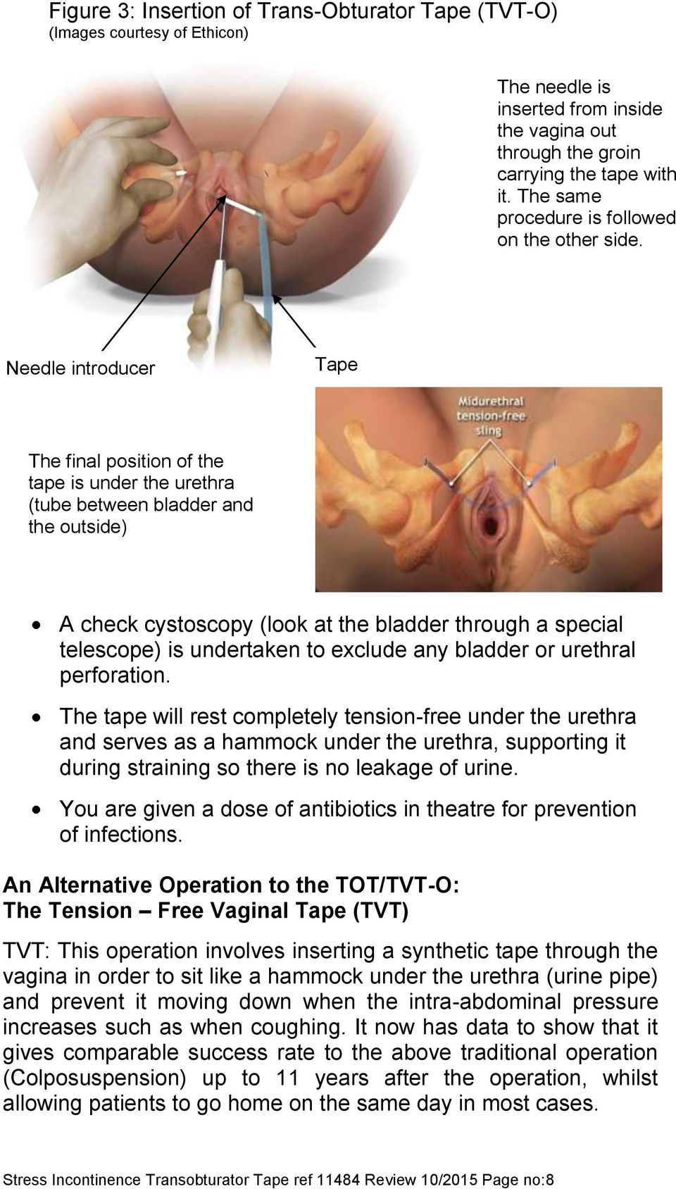 Needle introducer Tape Tape The final position of the tape is under the urethra (tube between bladder and the outside) A check cystoscopy (look at the bladder through a special telescope) is
