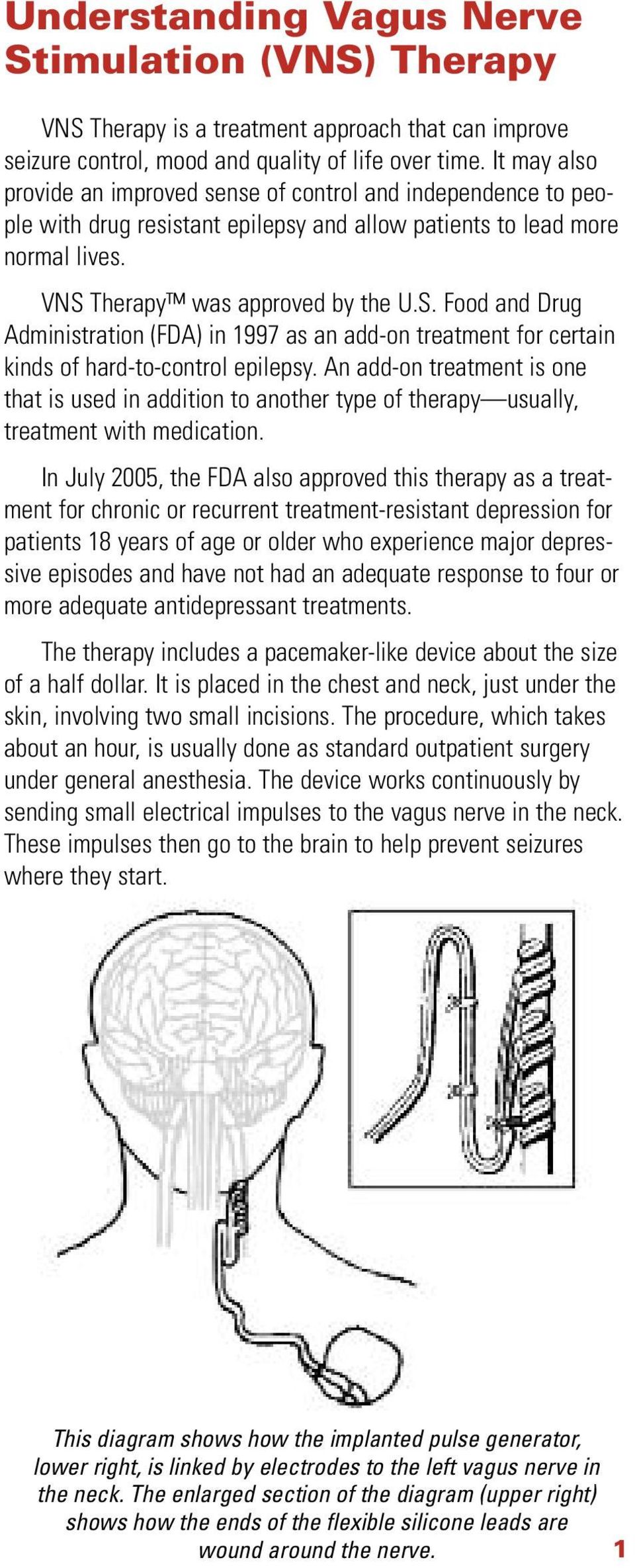 Therapy was approved by the U.S. Food and Drug Administration (FDA) in 1997 as an add-on treatment for certain kinds of hard-to-control epilepsy.