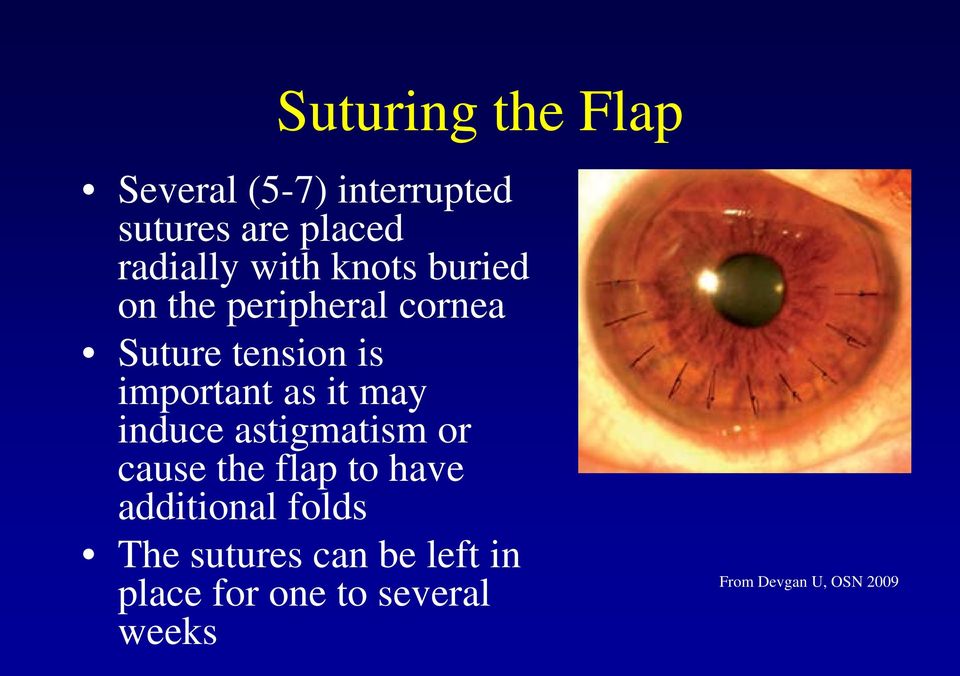 it may induce astigmatism or cause the flap to have additional folds The
