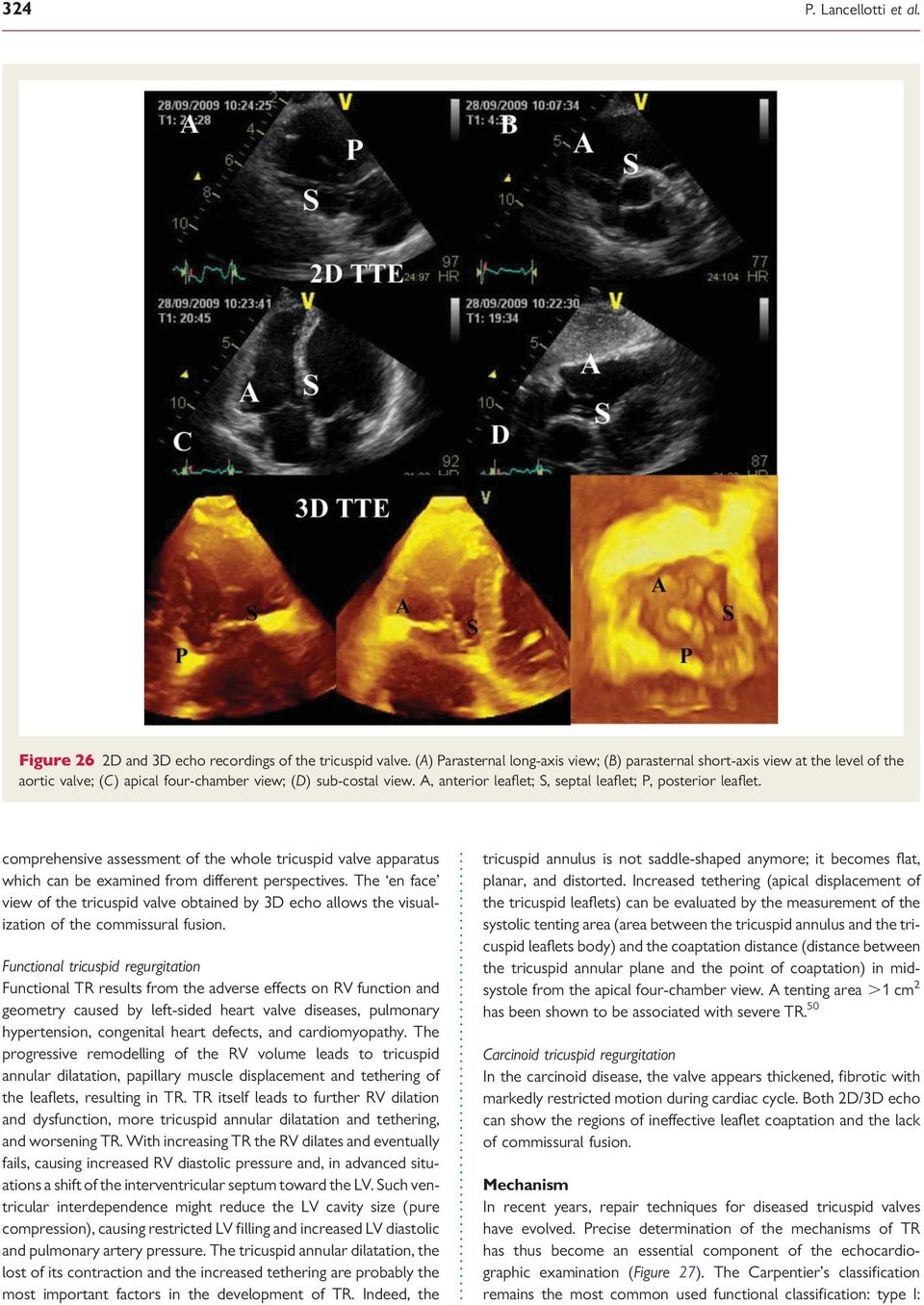 A, anterior leaflet; S, septal leaflet; P, posterior leaflet. comprehensive assessment of the whole tricuspid valve apparatus which can be examined from different perspectives.