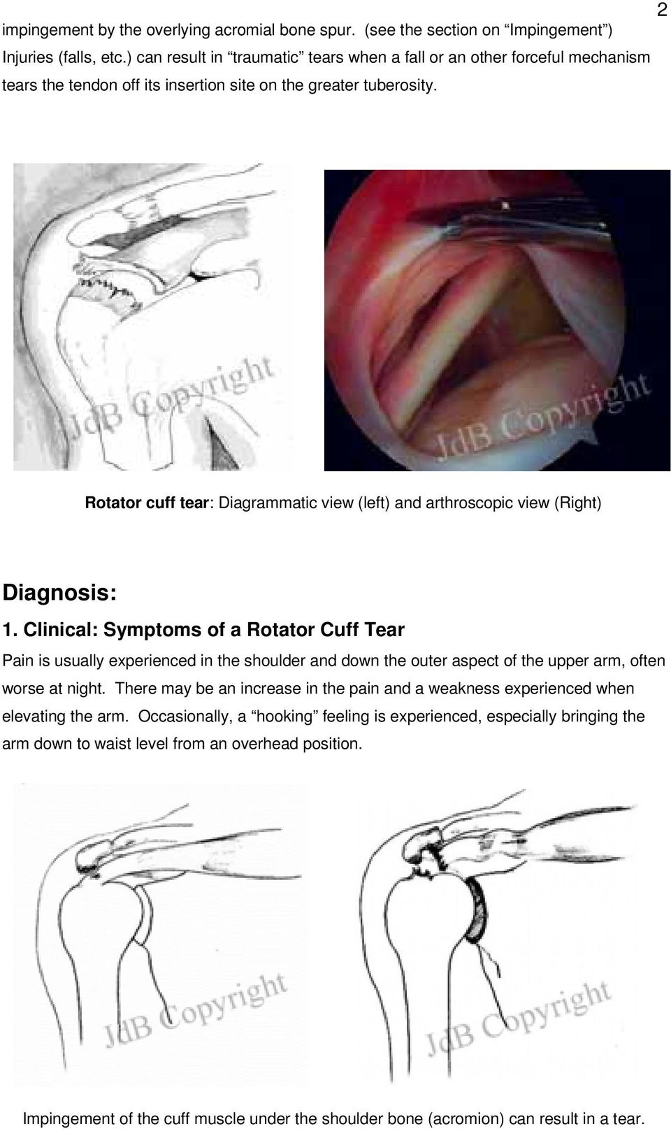 Rotator cuff tear: Diagrammatic view (left) and arthroscopic view (Right) Diagnosis: 1.