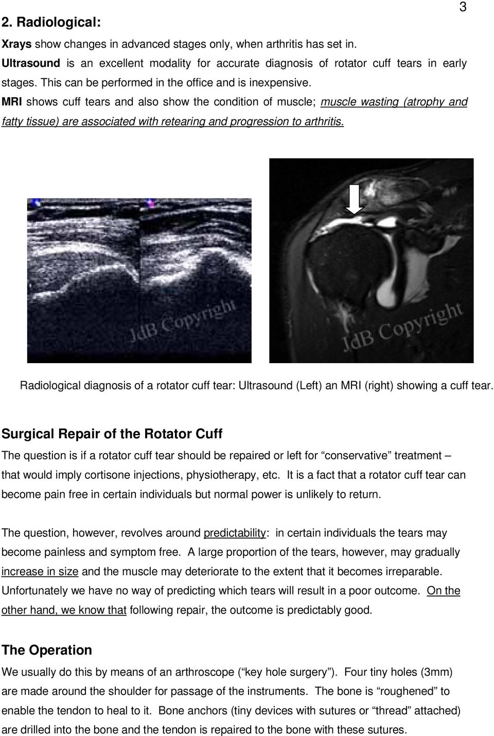 MRI shows cuff tears and also show the condition of muscle; muscle wasting (atrophy and fatty tissue) are associated with retearing and progression to arthritis.