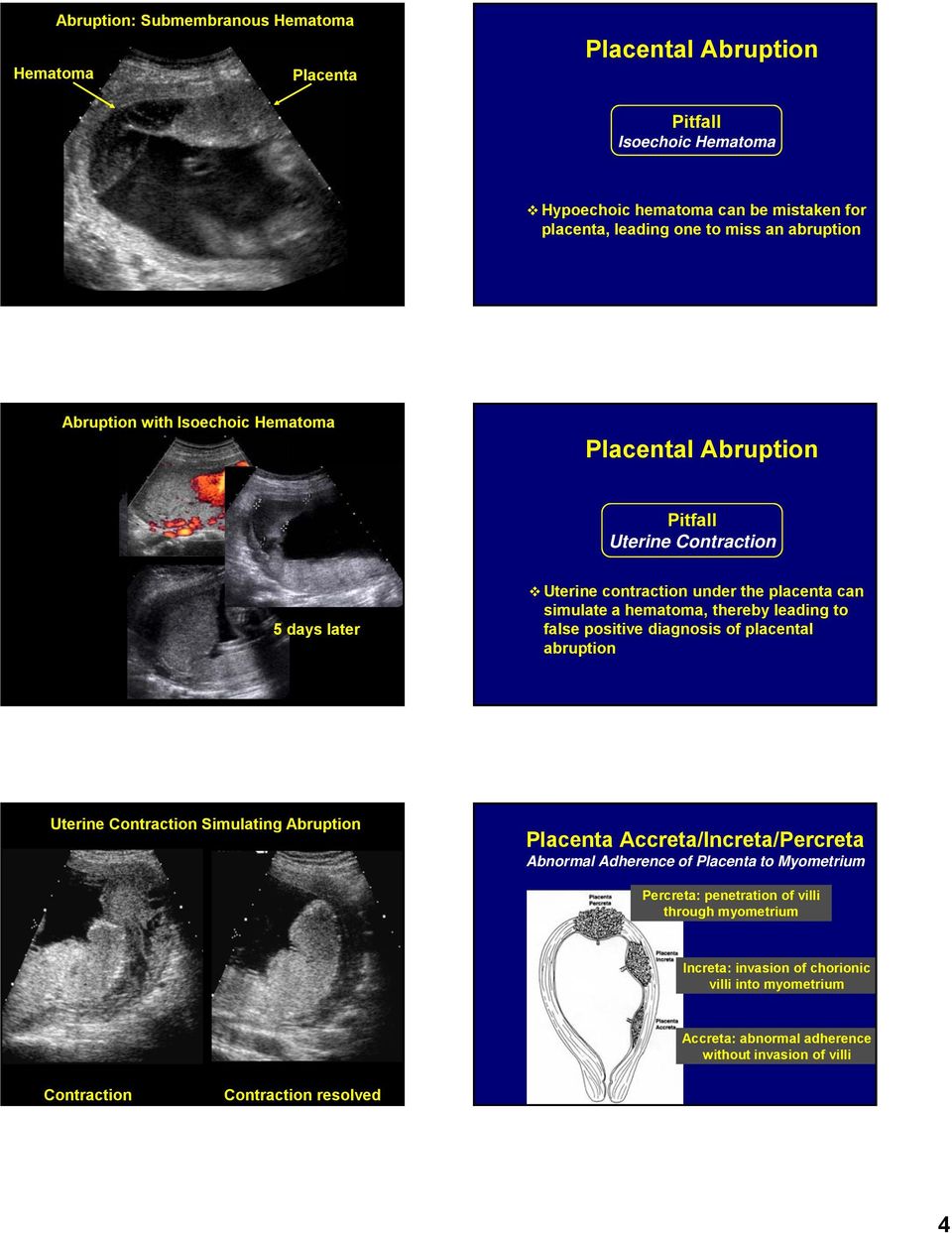 false positive diagnosis of placental abruption Uterine Contraction Simulating Abruption Ripley: contraction simulating abruption?