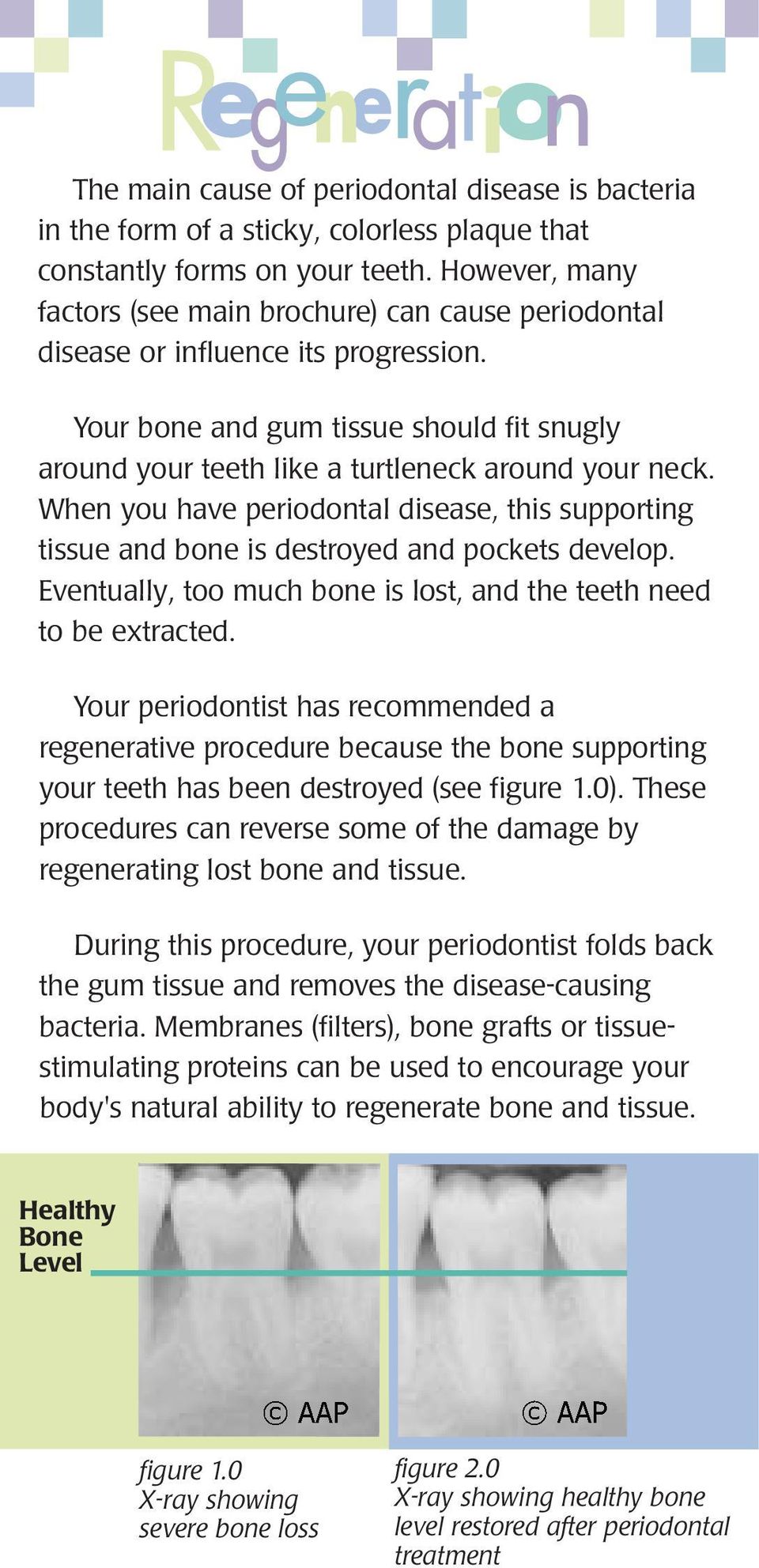 When you have periodontal disease, this supporting tissue and bone is destroyed and pockets develop. Eventually, too much bone is lost, and the teeth need to be extracted.