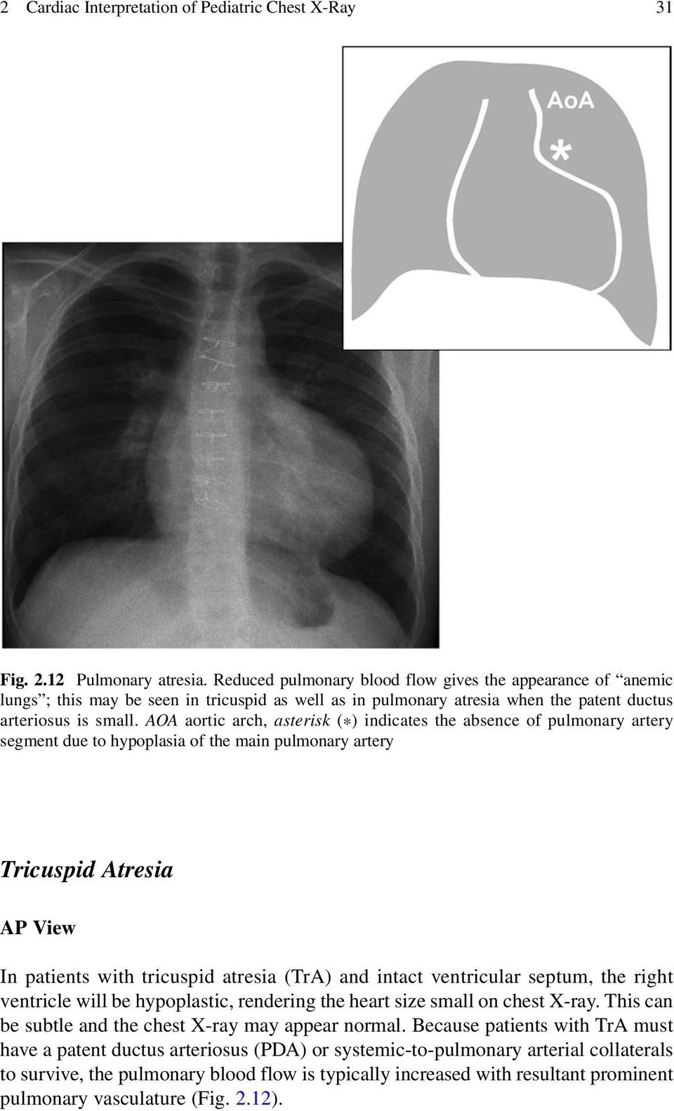 AOA aortic arch, asterisk (*) indicates the absence of pulmonary artery segment due to hypoplasia of the main pulmonary artery Tricuspid Atresia In patients with tricuspid atresia (TrA) and intact