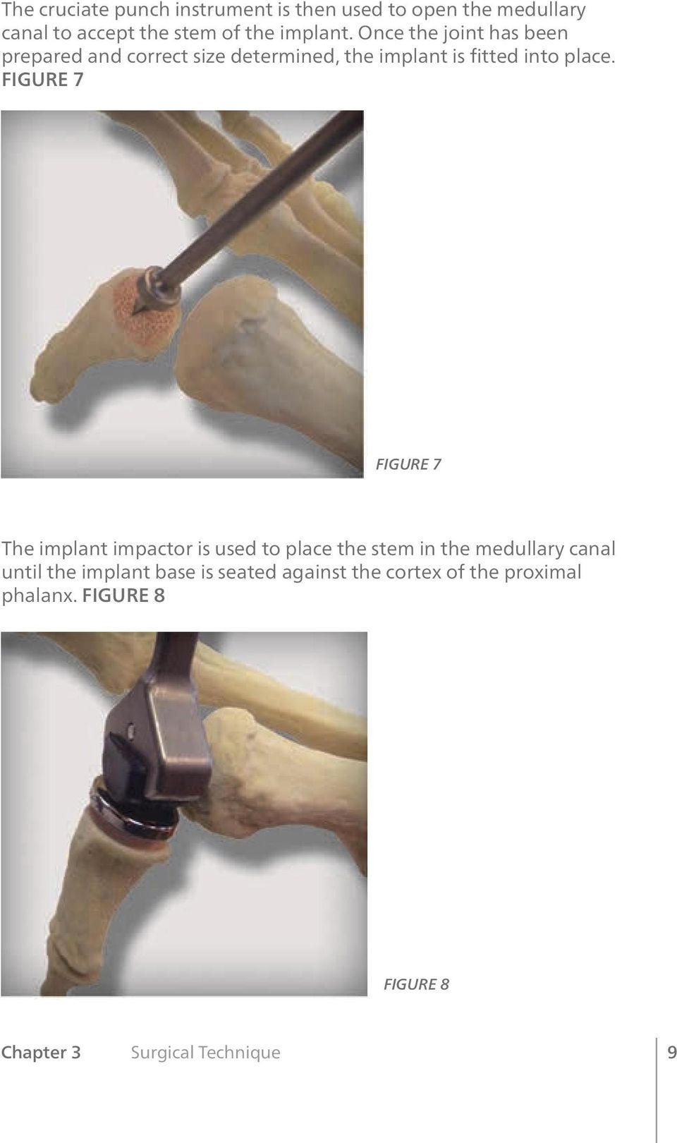 FIGURE 7 FIGURE 7 The implant impactor is used to place the stem in the medullary canal until the