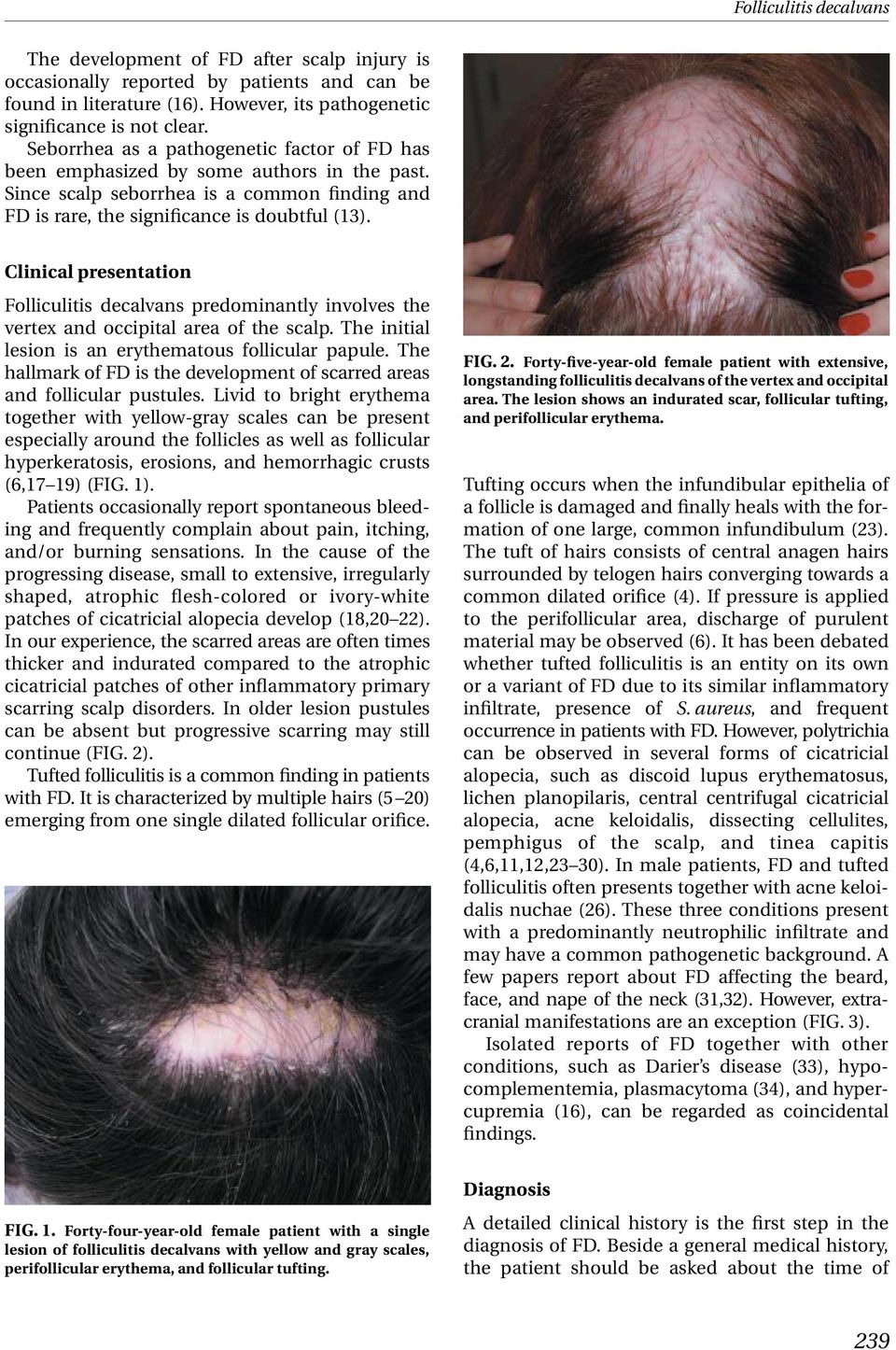Clinical presentation Folliculitis decalvans predominantly involves the vertex and occipital area of the scalp. The initial lesion is an erythematous follicular papule.