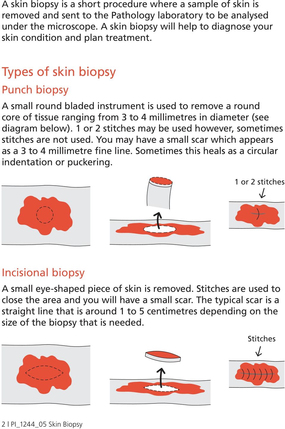 Types of skin biopsy Punch biopsy A small round bladed instrument is used to remove a round core of tissue ranging from 3 to 4 millimetres in diameter (see diagram below).