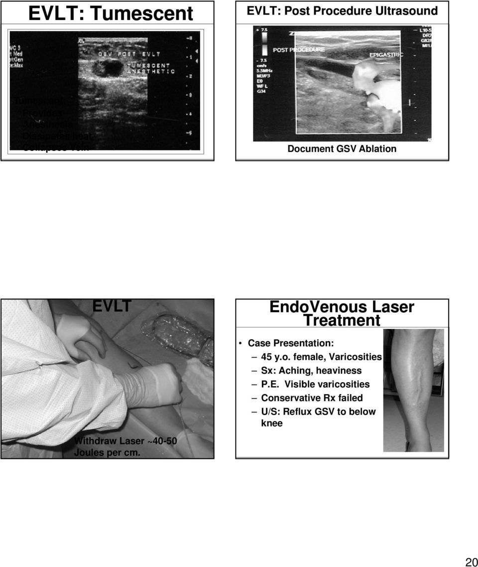 per cm. EndoVenous Laser Treatment Case Presentation: 45 y.o. female, Varicosities Sx: Aching, heaviness P.