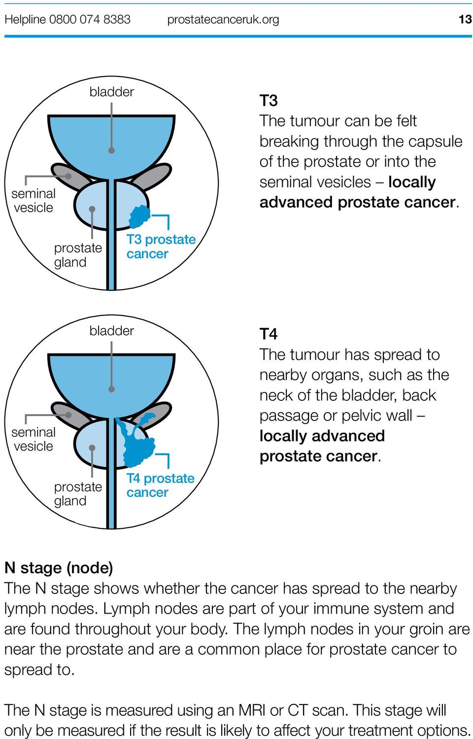 locally advanced prostate cancer. N stage (node) The N stage shows whether the cancer has spread to the nearby lymph nodes.