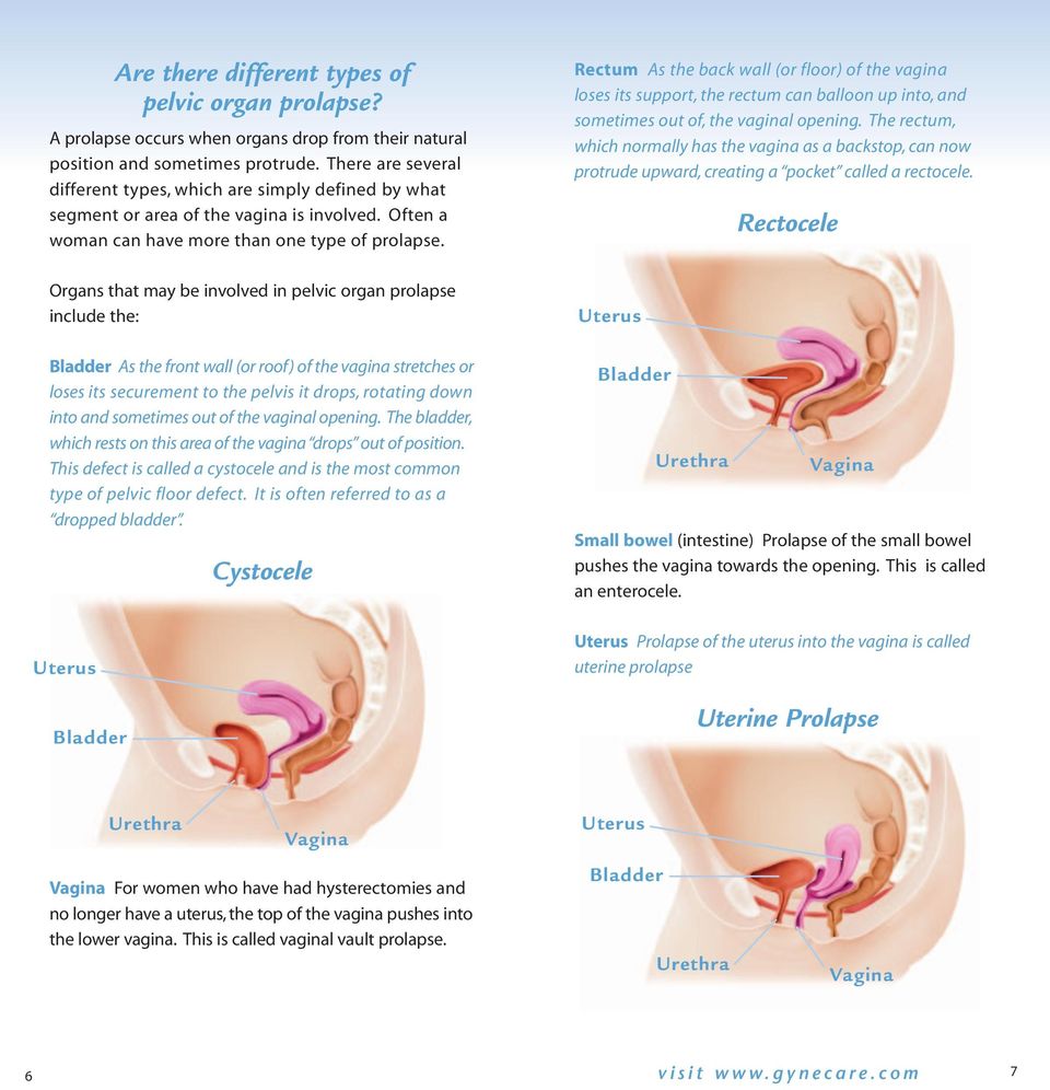 Organs that may be involved in pelvic organ prolapse include the: As the front wall (or roof) of the vagina stretches or loses its securement to the pelvis it drops, rotating down into and sometimes
