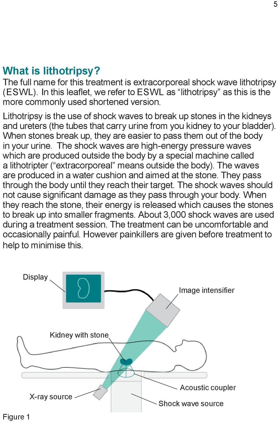 Lithotripsy is the use of shock waves to break up stones in the kidneys and ureters (the tubes that carry urine from you kidney to your bladder).