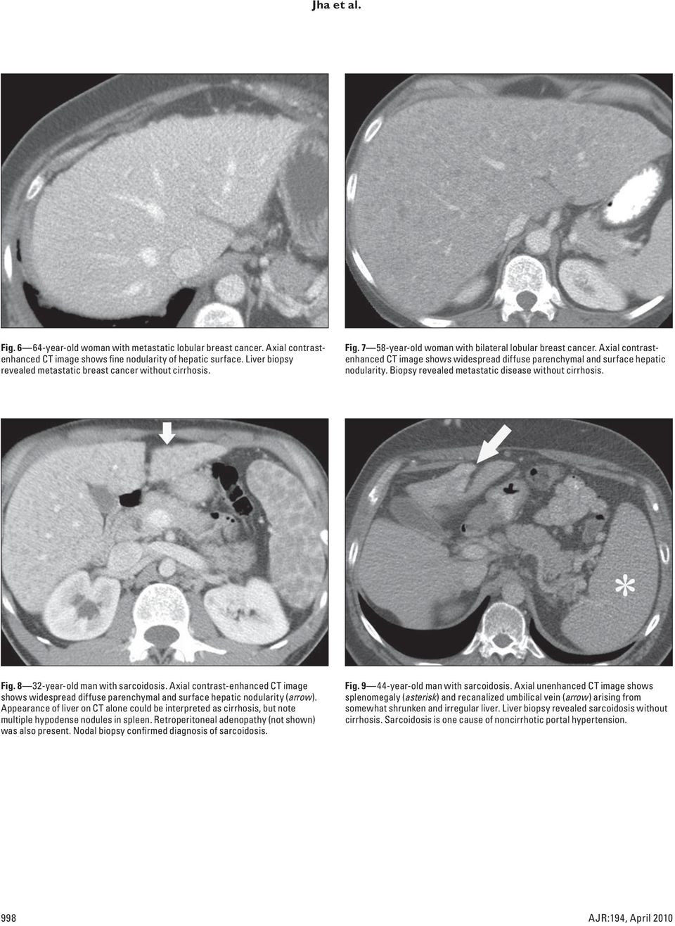 xial contrastenhanced CT image shows widespread diffuse parenchymal and surface hepatic nodularity. iopsy revealed metastatic disease without cirrhosis. Fig. 8 32-year-old man with sarcoidosis.