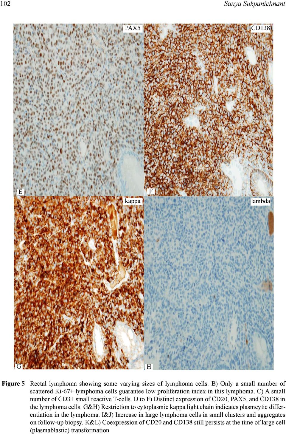 D to F) Distinct expression of CD20, PAX5, and CD138 in the lymphoma cells.