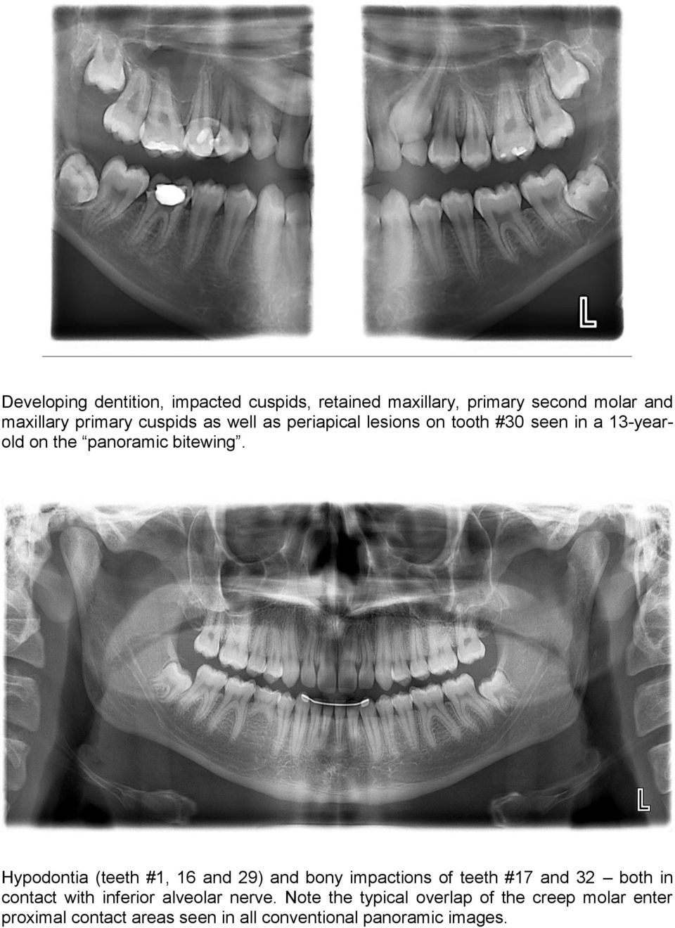 Hypodontia (teeth #1, 16 and 29) and bony impactions of teeth #17 and 32 both in contact with inferior