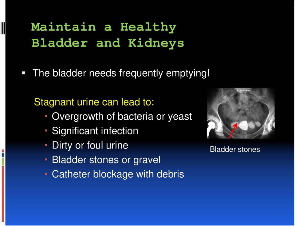 Stagnant urine can lead to: Overgrowth of bacteria or yeast