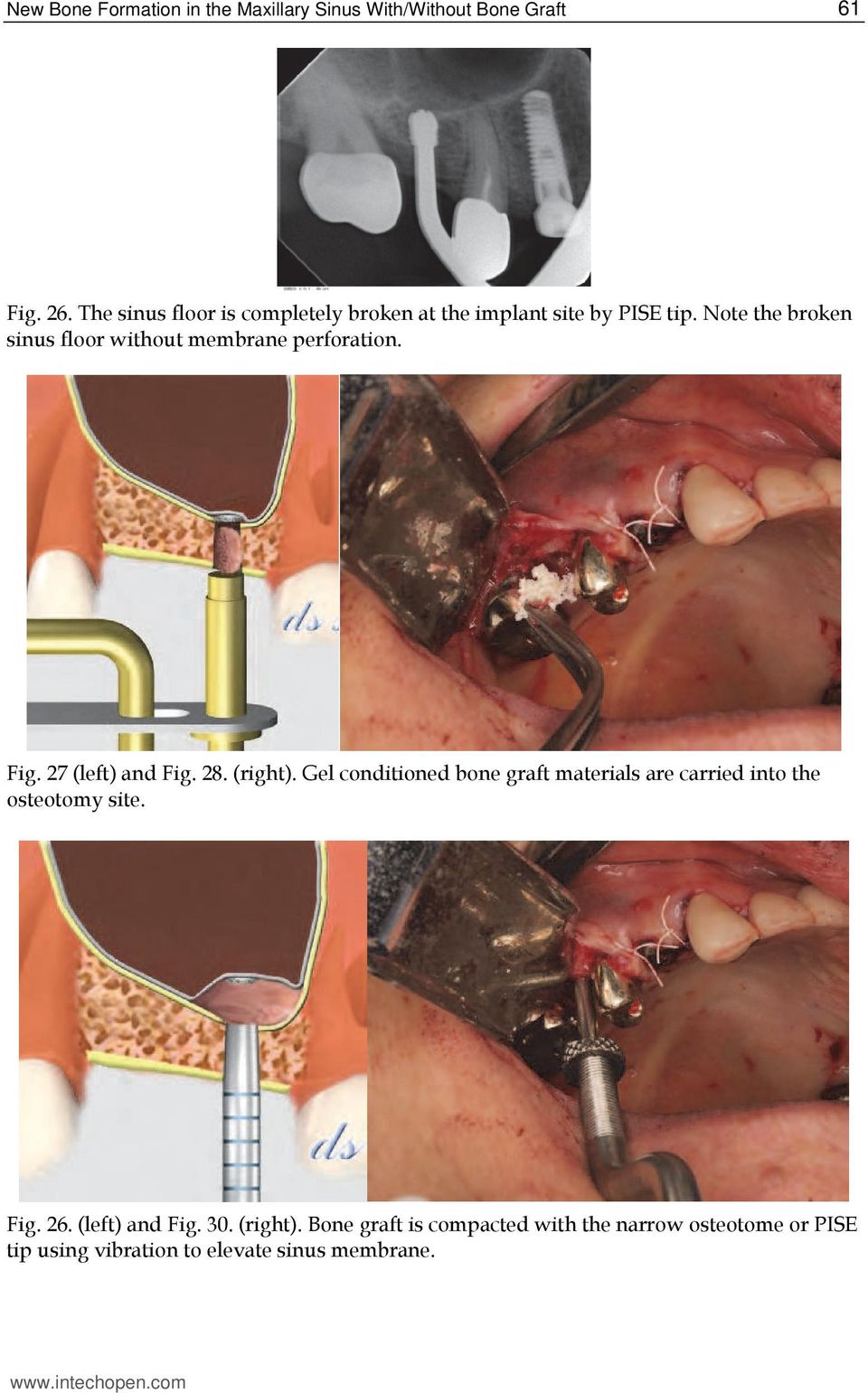 Note the broken sinus floor without membrane perforation. Fig. 27 (left) and Fig. 28. (right).