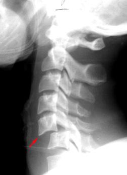 Bilateral Facet Dislocation Flexion injury Subluxation of dislocated vertebra of greater than ½