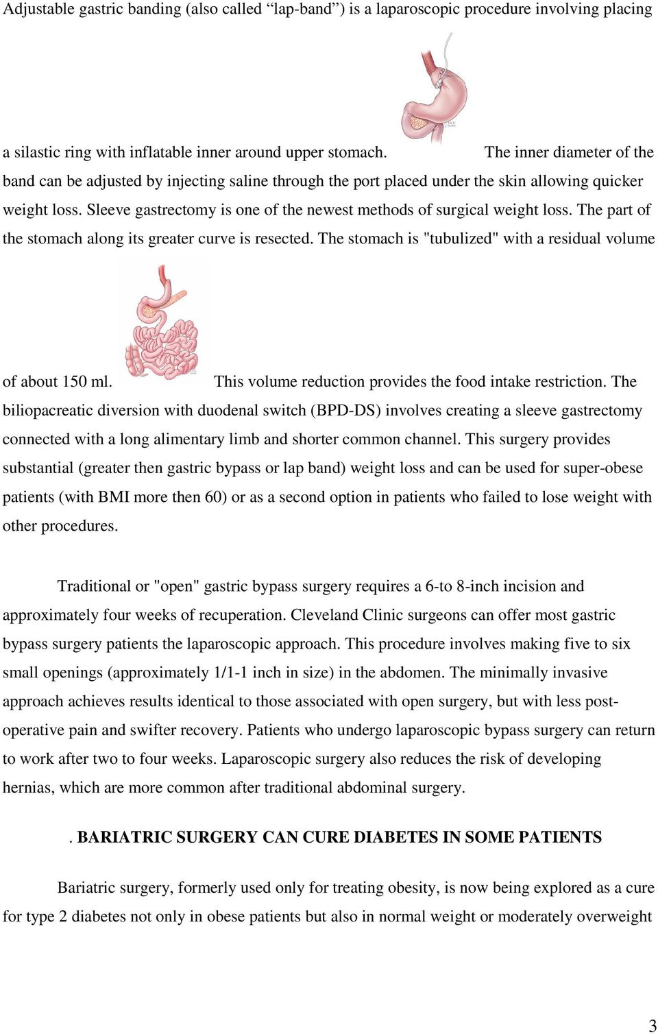 Sleeve gastrectomy is one of the newest methods of surgical weight loss. The part of the stomach along its greater curve is resected. The stomach is "tubulized" with a residual volume of about 150 ml.