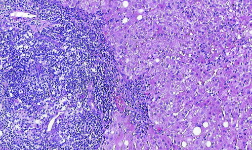Csepregi A et al. Budesonide for autoimmune hepatitis 1365 A B C D Figure 1 Histology of biopsy specimens obtained from a patient with AIH (A, B) and from a patient with AIH and PBC (overlap; C, D).