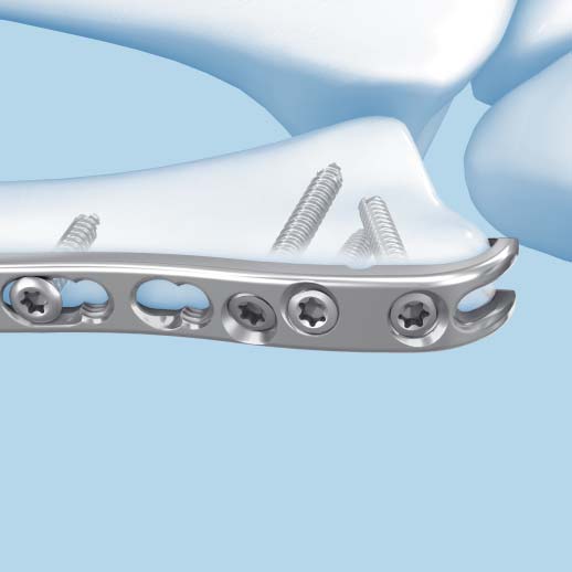 Adjust Length and Complete Fixation 5 Adjust length and complete fixation Multiple options for screw insertion in the distal portion of the plate allow a wide range of fracture patterns to be