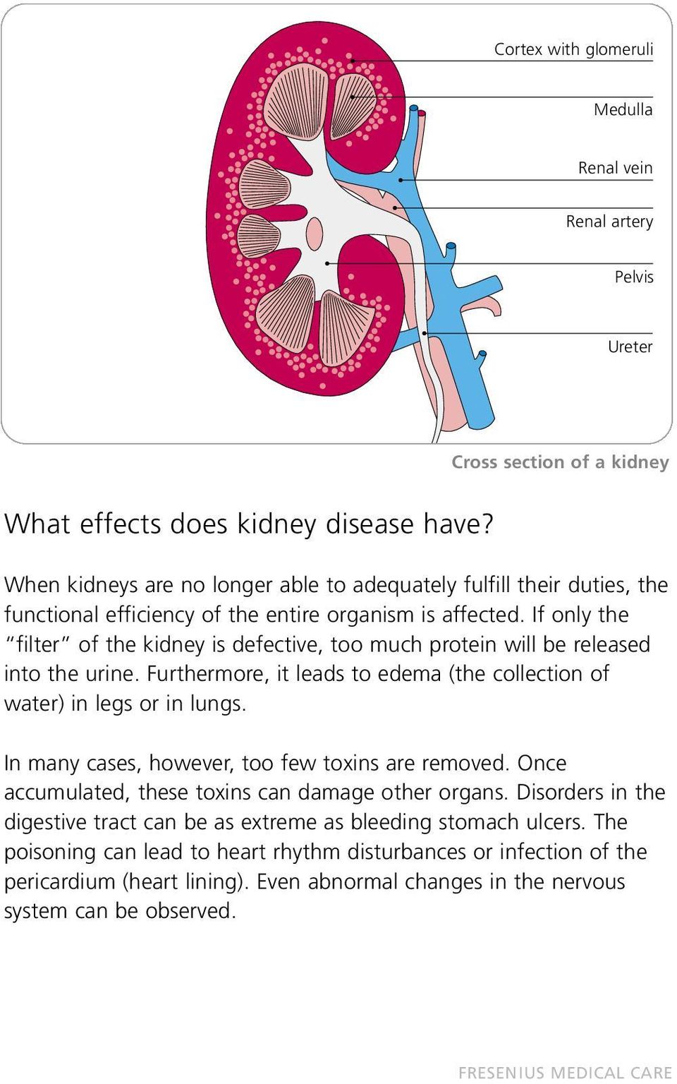 If only the filter of the kidney is defective, too much protein will be released into the urine. Furthermore, it leads to edema (the collection of water) in legs or in lungs.