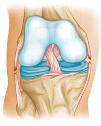 Posterior cruciate ligament tear (shown from back of knee). Collateral Ligament Injuries Injuries to the collateral ligaments are usually caused by a force that pushes the knee sideways.