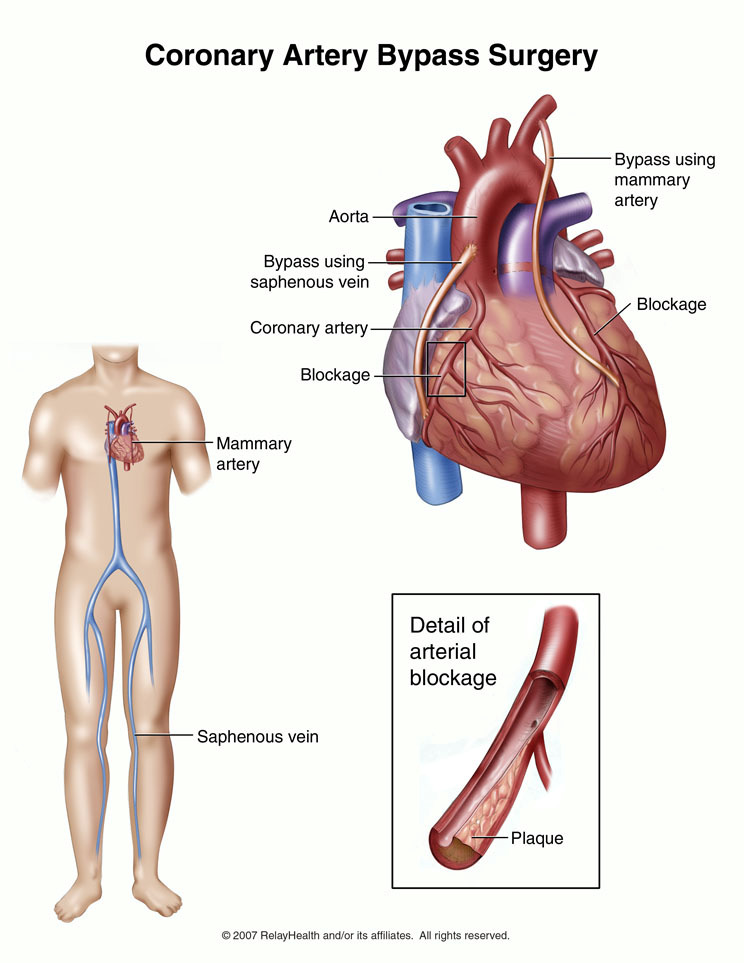 EQ 3 How do doctors treat a blocked blood vessel? Diagnosis Use an angiogram to detect a blocked blood vessel.