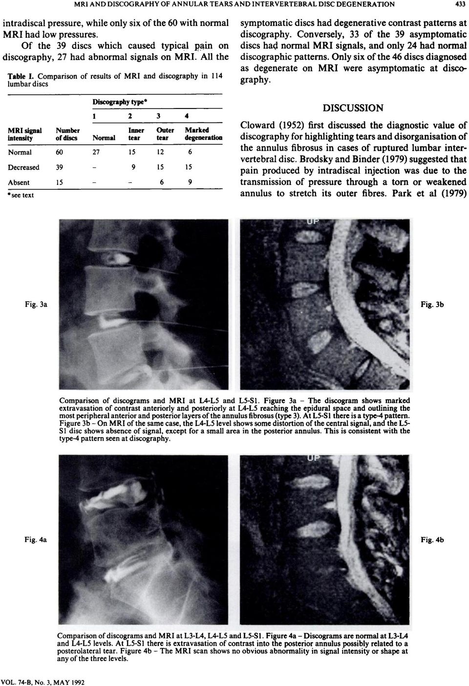 Comparison of results of MRI and discography in 114 lumbar discs symptomatic discs had degenerative contrast patterns at discography.