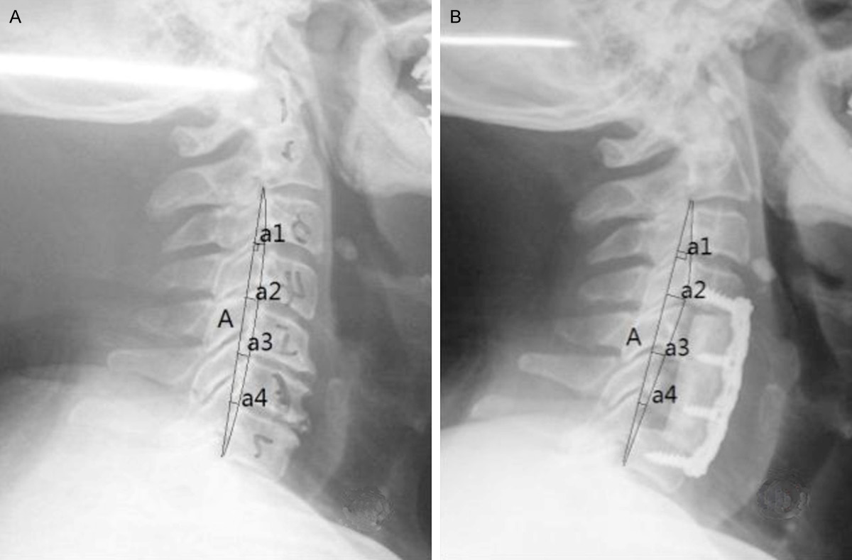 Figure 2. CCI measurement: a lateral radiograph was obtained, and a line connecting the posterior lower corner of C2 and C7 was drawn.