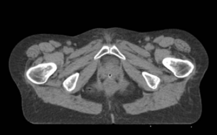 Treatment Procedure! MRI merged with CT-planning! SIB: the upper 2/3 of vagina!