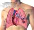 Deep Vein Thrombosis or Pulmonary Embolism