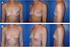 Breast reconstruction using an implant after risk-reducing surgery